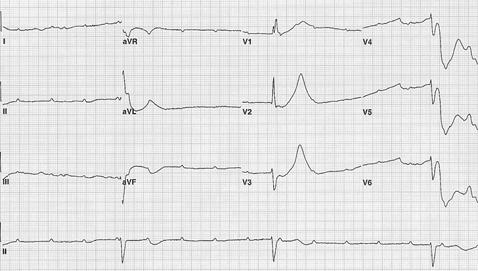 -Inhae Park, et al : A case of Kearns-Sayre syndrome complicated with complete AV block - Figure 1. EKG on admission showing complete AV block with ventricular rate of 33 beats/min. Figure 2.
