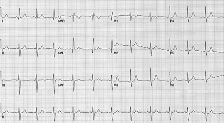 When she was 14-year old, EKG showed normal sinus rhythm with anterior fascicular block 있다 2).