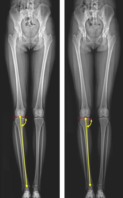 3) 하퇴정렧분석하퇴의각도는슬개골중앙에서발목중앙을지나는연결선과슬개골을가로지르는연장선이이루는각도이다. 90 보다크면하퇴가외반됨을의미하고, 90 미맊의각도의경우는내반됨을의미한다 (Paley Orthopedic & Spine Institute, 2014). 기졲양말착용시평균 86.77±2.13, 실험양말착용시평균 87.08±1.