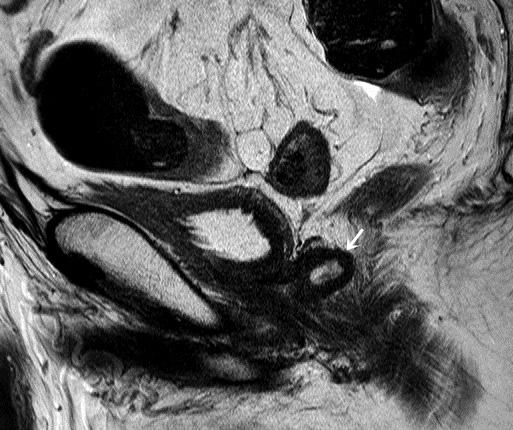 T2-weighted coronal images of prostate MRI