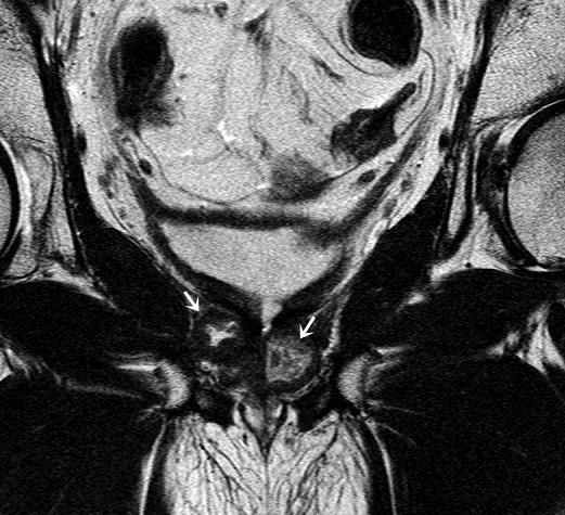 I-K. T2-weighted sagittal images of prostate