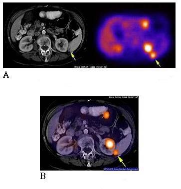 Fig. 4. The PET/CT fusion image (A) CT data (left) and PET data (right), (B) PET/CT fusion image. 대략 5~10분정도소요된다. CT촬영이끝나면바로침대를 PET촬영위치로옮겨서분절당 6~10분동안방출촬영을하며전체방출영상을얻는데는 45~60분정도걸린다.