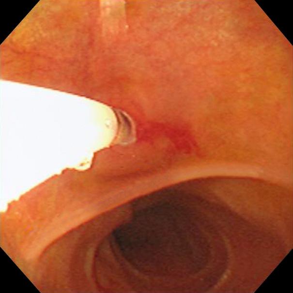 448 대한소화기내시경학회지 2007;35:445-450 Figure 4. Use of a rotatable papillotome to cannulate the bile duct in case 2.