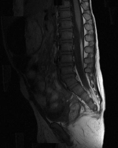 Result Correlation of plain film, spinal sonography, and lumbosacral MRI From the morphological point of view, 95 patients did not show an evidence of