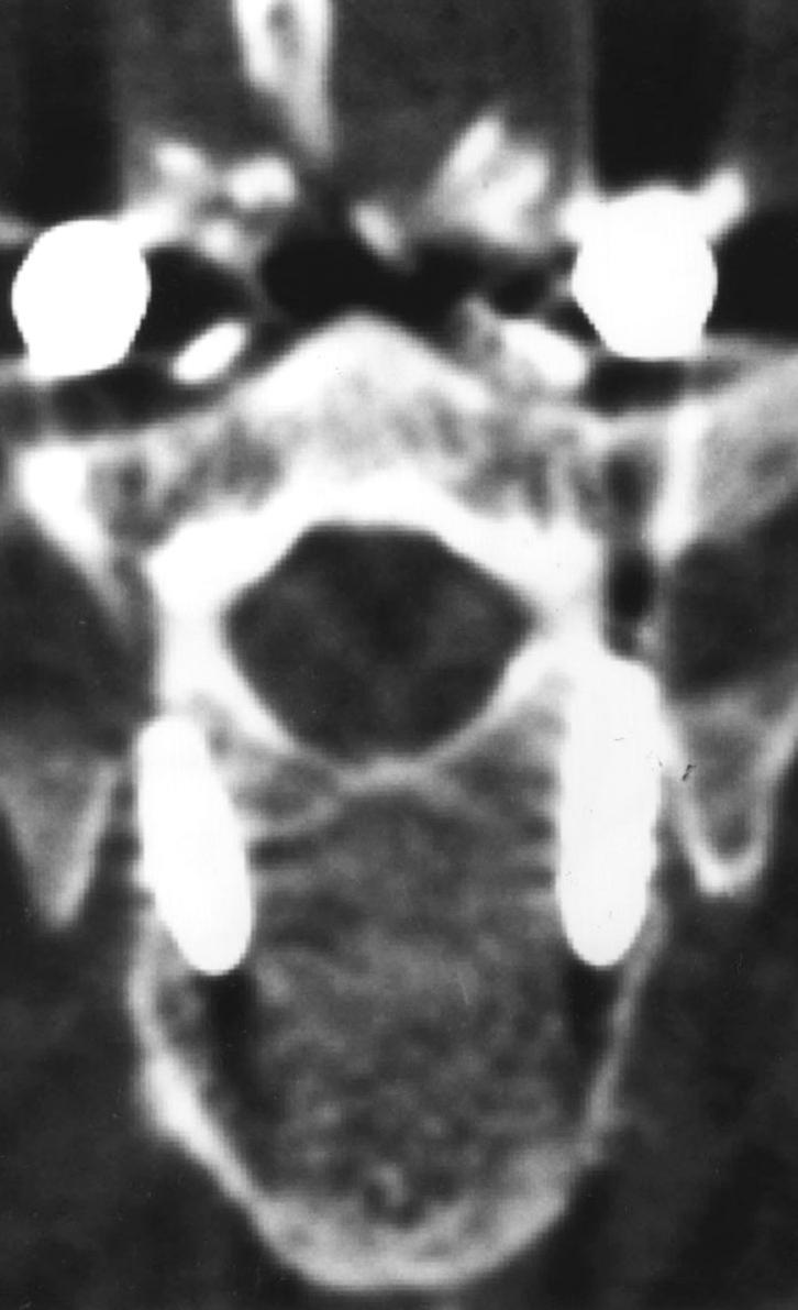 Postoperative plain anteroposterior() and lateral() films show pedicle screw instrumentation at T6-10 level.