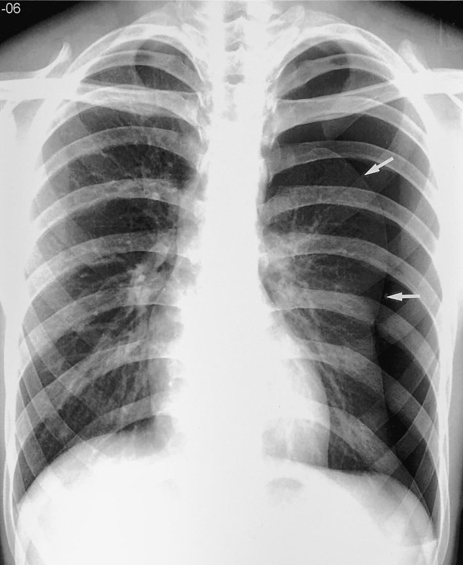 Fig. 1. Spontaneous pneumothorax in a 21-year-old man.