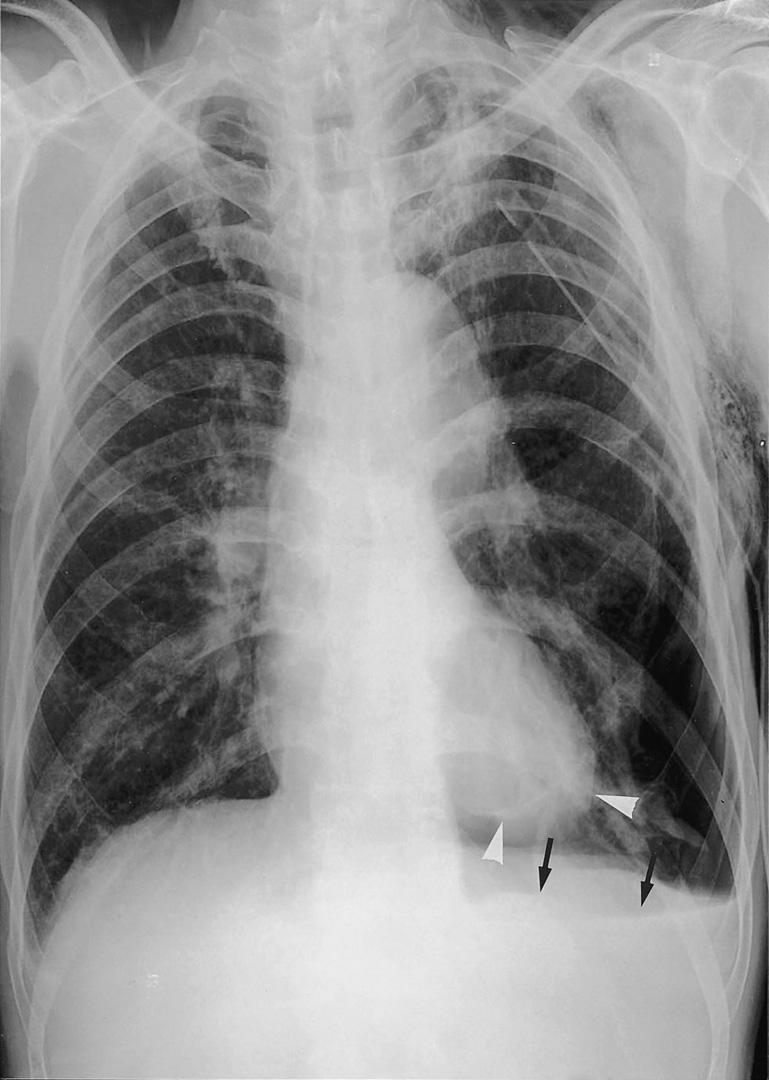 전경녀 외: 기흉, 기종격증, 심막기종 Fig. 2. Pneumothorax on the left after motor vehicle accident in a 71-year-old man.