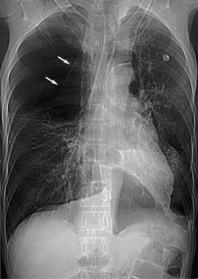 () Frontal chest radiograph shows a focal hyperlucency without vascular markings in right upper lung.