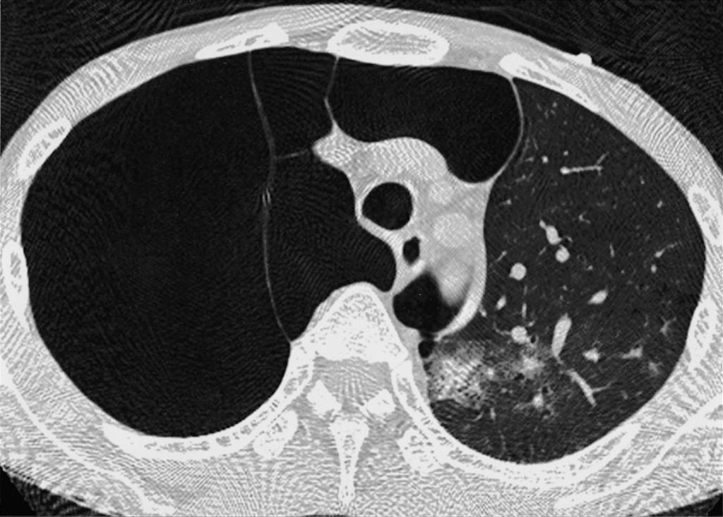 () CT image shows multiple large bullae in the right lung. Fig. 5. Pneumothorax in a 46-year-old man with multiple large bullae.