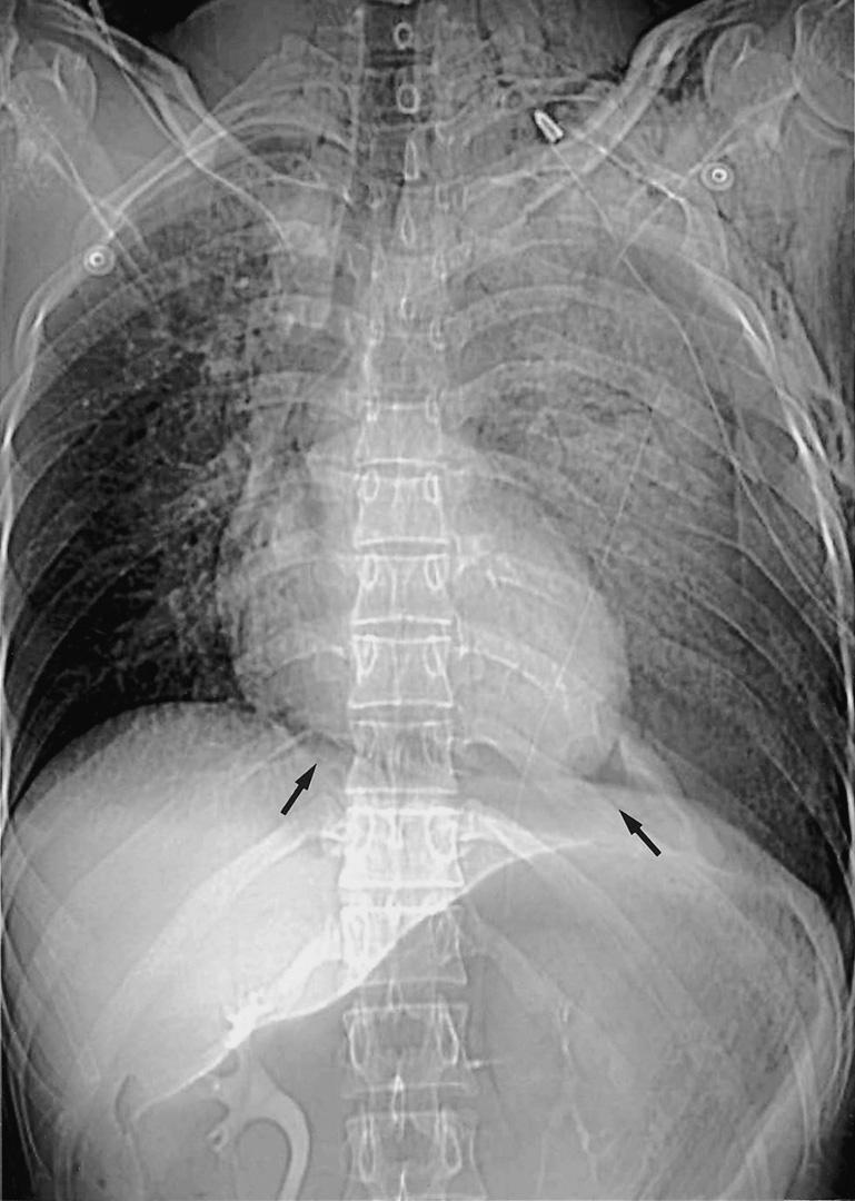 Fig. 15. 29-year-old man with pneumopericardium from blunt trauma. () Frontal radiograph shows broad band of gas encircling the heart (halo sign, arrows).