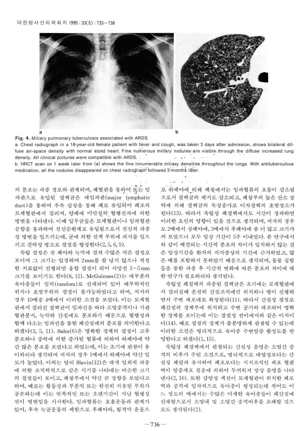 대한방사선의학회지 995 ; 33(5) : 733-738 a Fig. 4. Miliary pulmonary tuberculosis associated with ARDS a.