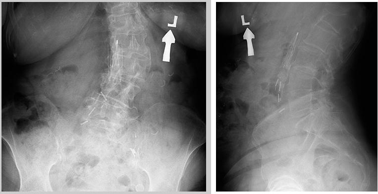 L1 compression fracture on spine radiographs, which also document an