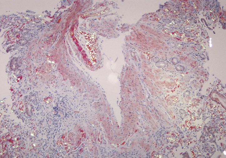 Uniform joint space narrowing and periarticular osteopenia. Figure 4. Congo red with polarizing microscope ( 100).