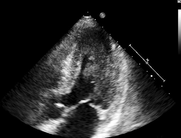 Secondary Amyloidosis in a Patient with Juvenile Rheumatoid Arthritis 283 Figure 5. Transthoracic echocardiogram.