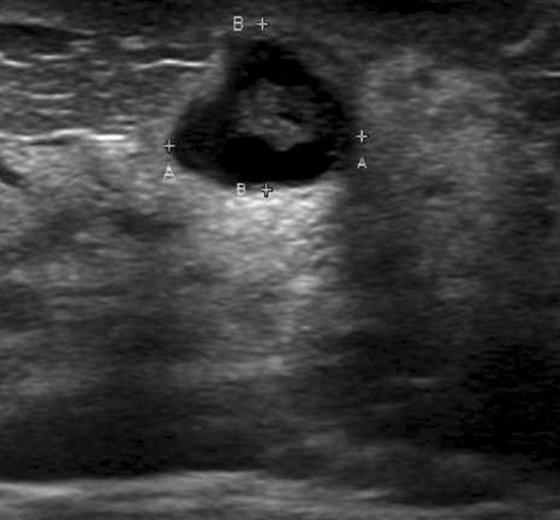 J Surg Ultrasound Vol. 3, No. 1, 2016 본 론 1) 복합 낭종(Complex cyst) 유방낭종에 내부 에코가 보일 때에는 대부분 단백질이 1.