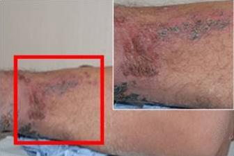 - 대한내과학회지 : 제 81 권제 5 호통권제 615 호 2011 - A B Figure 2. (A, B) Two photographs showing healing of the lesions after 2 weeks. 플루엔자바이러스등모두음성으로세균및바이러스감염은없었다.