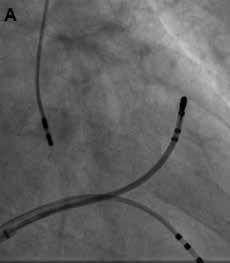 A, Catheter tip position on the ablation success point, targeting the ventricular tachycardia originating from the right ventricular outflow