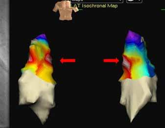 B, 3D electroanatomic mapping shows that the focus of ventricular tachycardia originated from the right ventricular outflow tract.