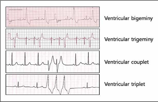 Ventricular bigeminy Main Topic Reviews Ventricular trigeminy Ventricular couplet Ventricular triplet Figure 1. Electrocardiograms of various premature ventricular contraction patterns.