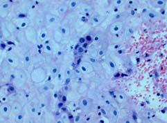 탈락막자연살해세포의아형검사 (Decidual NK cell subtype test) 1) 탈락막자연살해세포의면역조직화학염색 (Immunohistochemical staining) (1)