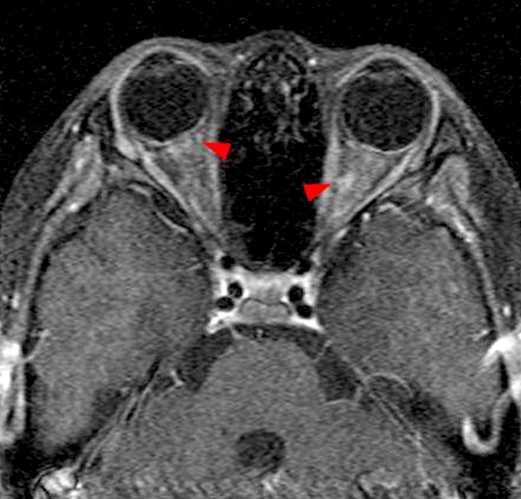 adjacent lesion (arrow head). 유전자 검사, 시신경척수염(neuromyelitis optica, NMO) 꺼워져 보이지만 신호 강도의 변화는 보이지 않았다.