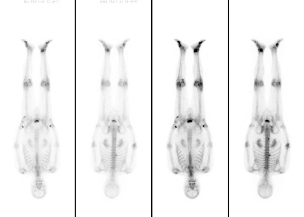 180 Ju-Oh Kim, et al. nterior Tc-99m HDP whole body bone scan IV SITE:LT.elbow Posterior nterior Posterior Figure 4.