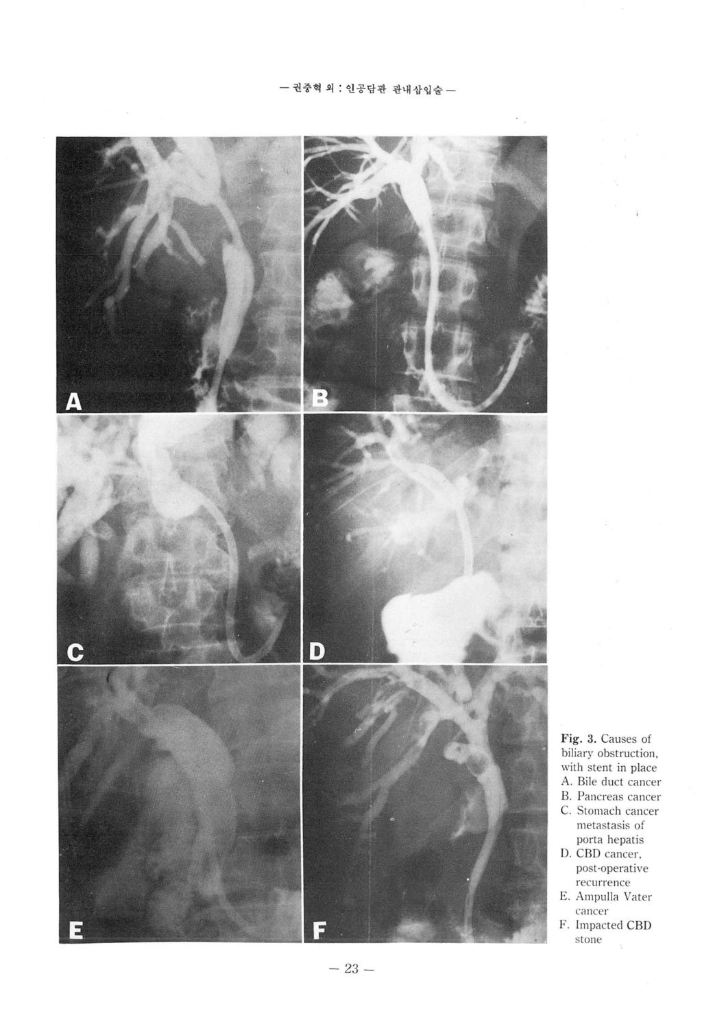 % ω- 권중혁외 : 연공당관관내삽입술 - F ig. 3. Causes of biliary obstruction, with stent in place A. Bile duct cancer B. Pancreas cancer C.