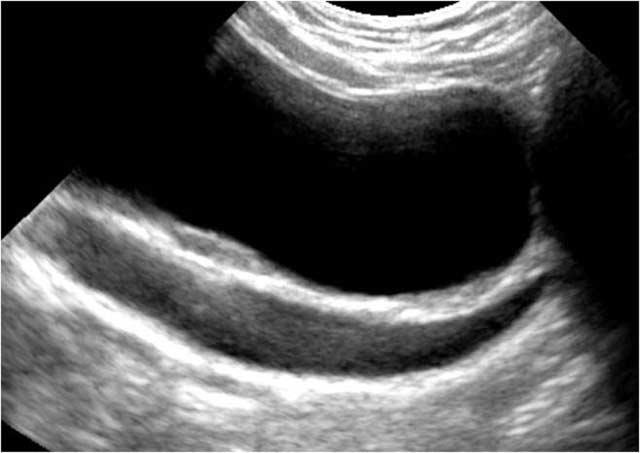 . Longitudinal scan of the urinary bladder shows dilated retrovesical ureter with lower ectopic insertion. Fig. 4. Primary megaureter in a 2-year-old boy.