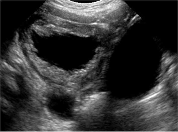 대한초음파의학회지 2013;32(2) urethra( keyhole sign) 가보이게된다 [23]. 이는 transabdominal 또는 transperineal 영상에서모두관찰할수있으나, 소변이잘차지않은경우에는보기어렵다. 그외에신장형성장애, 요성복수, subcapsular or perirenal urinoma 등이보일수있다.