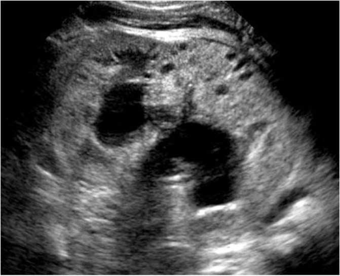 Prune elly syndrome (Eagle-arret syndrome) Prune elly syndrome은특징적으로복벽근의형성부전, 요로계기형, 그리고잠복고환의소견을보이는질환이다 [24]. 대부분신생아시기에진단되며, 거의모든환자가남아이다.