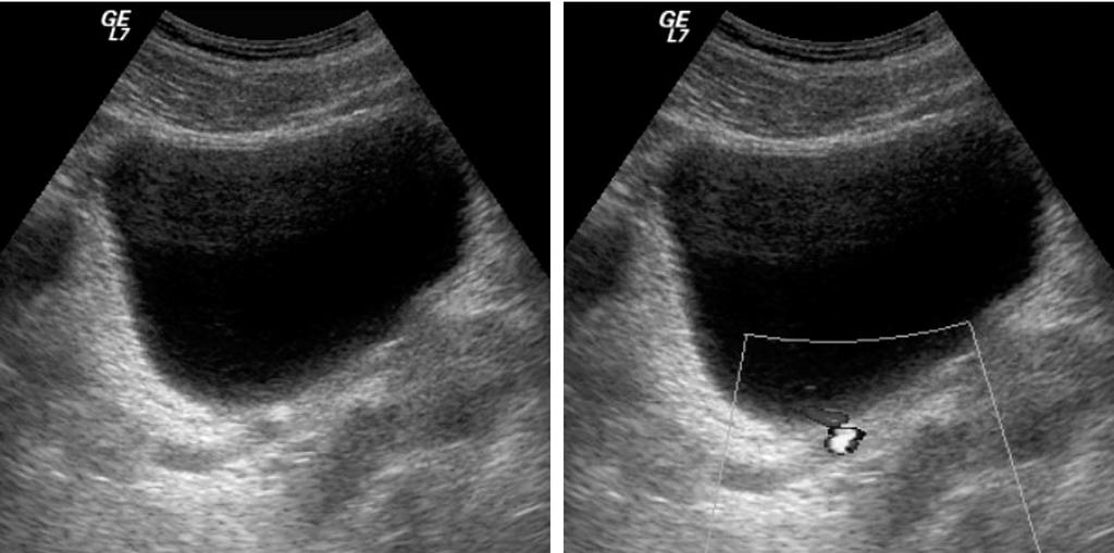Gray scale transabdominal sonogram shows distinct echogenic stone with posterior acoustic shadowing within dilated distal urinary tract.
