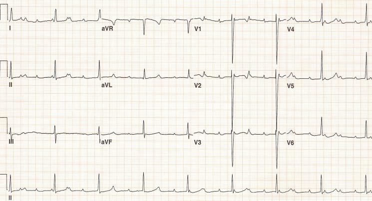 CASE 7-2 EKG at birth( 1 month ) 05, Jung RY,