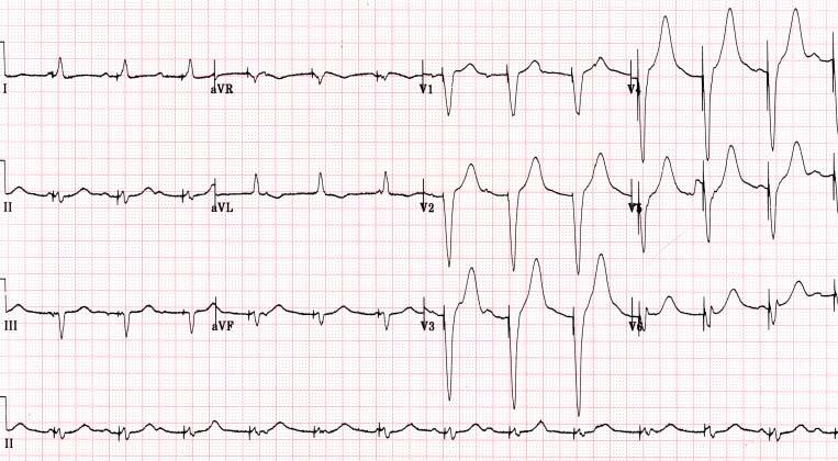 CASE 9-4 05, Joo BMJ, # 3879394 EKG after temporary pacemaker