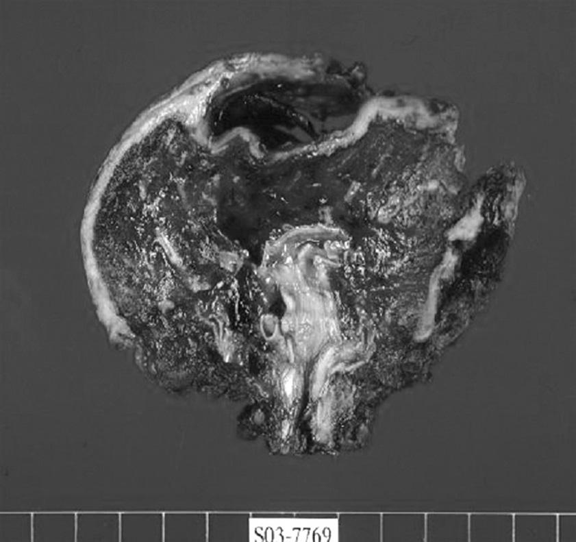 백종현 외 Pulmonary Epithelioid Hemangioendothelioma Fig. 2. Postoperative gross findings and microscopic findings.