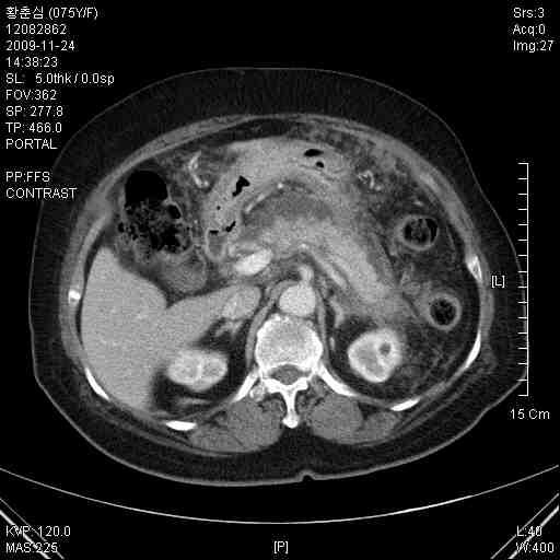 췌장염및합병증 < Acute pancreatitis 에서 abdomen CT 예 > ( pancreas 가 swelling 되어있으며주위로저음영의 fluid