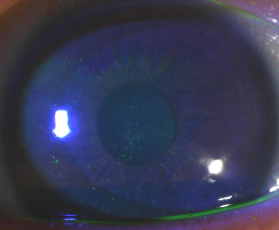 - 최윤정외 : 클라미디아시타시각결막염 1 예 - Figure 3. nterior segment photographs after two weeks of treatment show decreased punctate epithelial erosion () and papillae (). 고 찰 Figure 4.