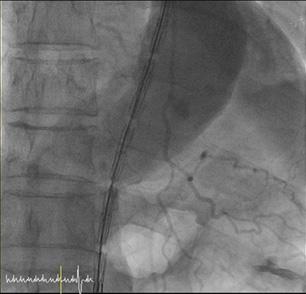 (B) An aortic stent graft was positioned in the intimal tear site at the mid-thoracic aorta.