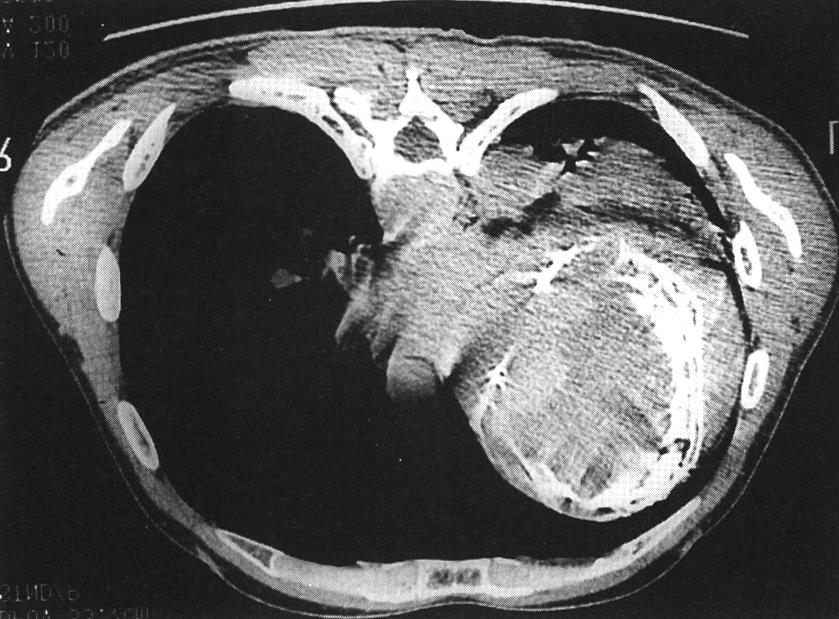 있었으며, 색 도플러상에서 대동맥에서 동맥류 내로 혈 수술 소견 환자는 거대한 동맥류의 파열 가능성 때문 류를 관찰할 수 있었고 I/IV 도의 대동맥판막 역류증을 에 흉부외과로 전원되어 수술을 실시하였다. 파열부위는 보였다(Fig. 5).