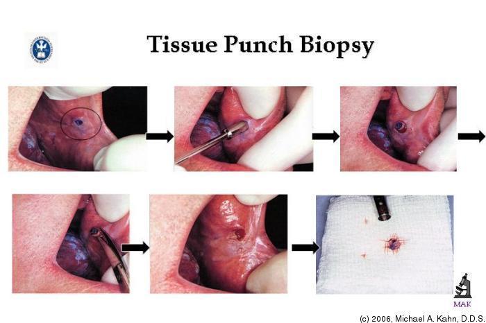 검체의채취 생검 (biopsy)