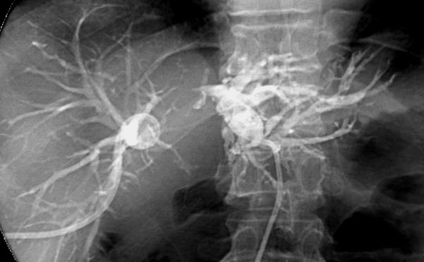 Two pigtail catheters were inserted for drainage. (C) Cholangiogram reveals obliteration of the hilar ducts.
