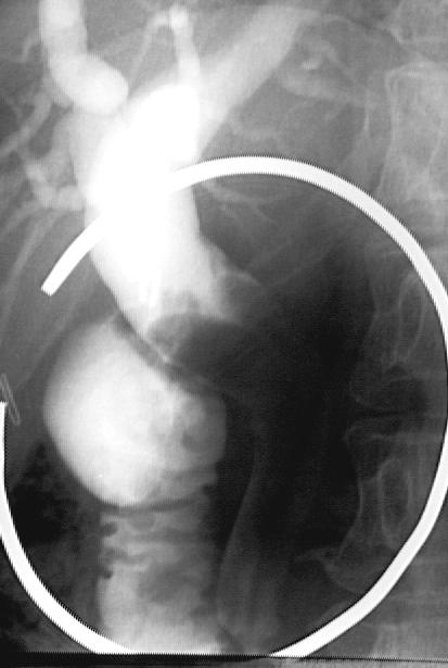 (A) computed tomography (CT) shows a small papillary tumor in the cystic duct (arrow). (B) Distal common duct is dilated without definite obstructing cause.