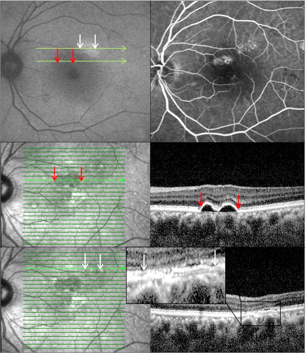 - 오인석 장지혜 : 만성 중심장액맥락망막병증에서의 망막외층변성 - A B C D Figure 3. Patient with 16 months of history of central serous chorioretinopathy in the left eye (Case 1).