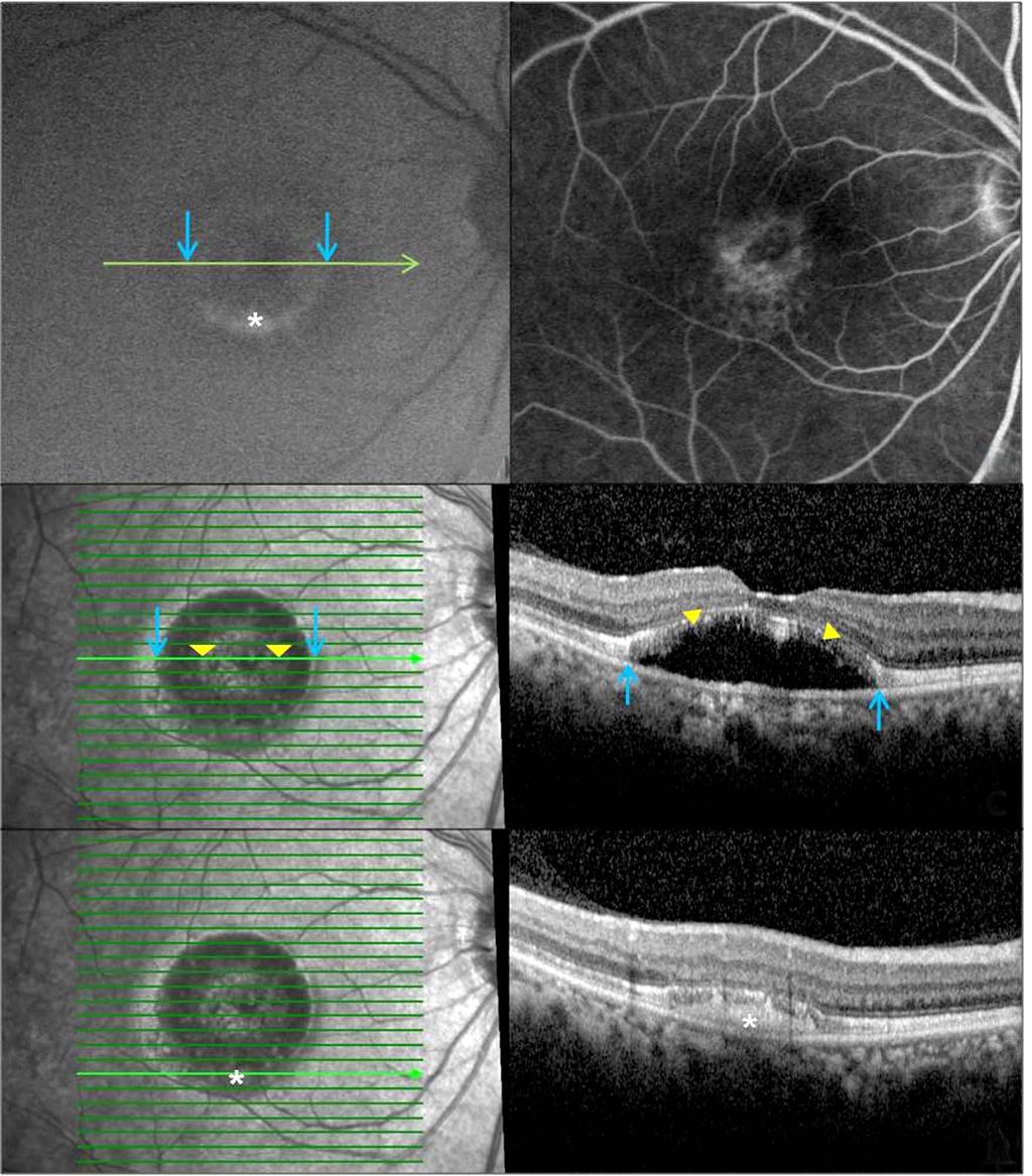 - 대한안과학회지 2016 년제 57 권제 5 호 - A B C D Figure 4. Patient with 11 month history of central serous chorioretinopathy in the right eye before treatment (Case 3).