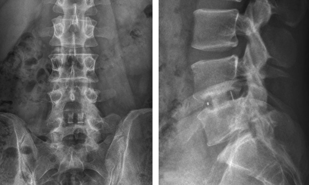 Journal of Korean Society of Spine Surgery Posterior Ring pophysis Fracture (PRF) Treated y Immobile ony Fragment Excision Fig. 5.