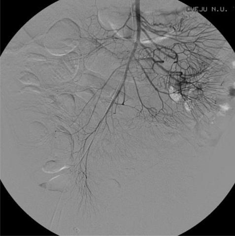 - Heung Up Kim, et al: Variceal bleeding of ascending colon associated with alcoholic liver cirrhosis - A B Figure 2. Superior mesenteric artery (SMA) angiogram.