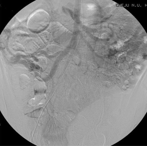 (B) Delayed venogram demonstrates colonic varices on the proximal ascending colon with markedly engorged ileocecal and retroperitoneal veins.