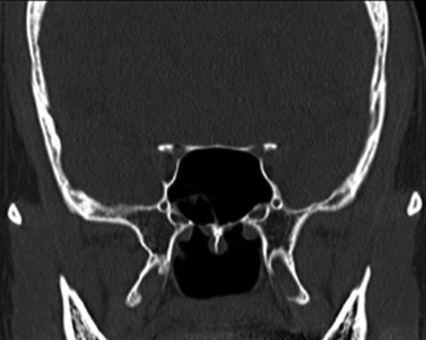 frontal sinus beyond the right lamina papyracea on the side of aplastic sinus.