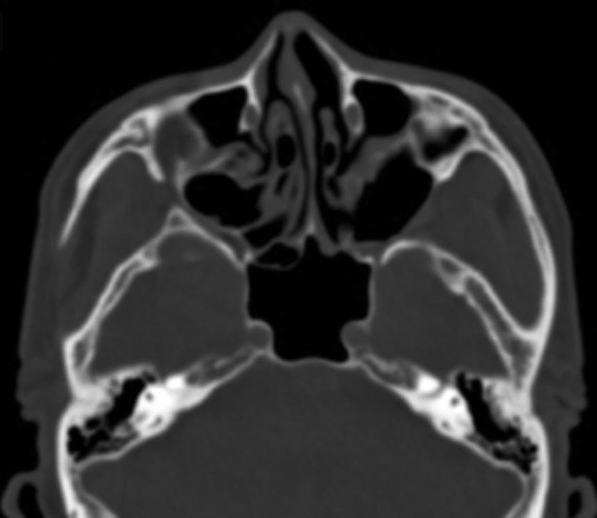 Coronal (A) and axial (B) computed tomography images of the paranasal sinuses.