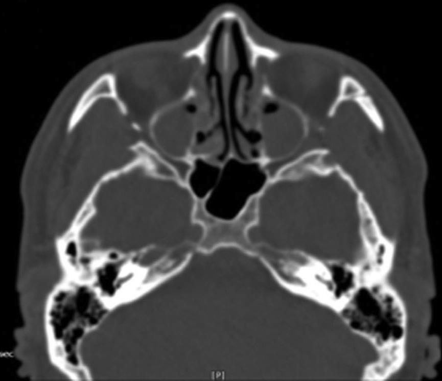 Computed tomography images of the paranasal sinuses.