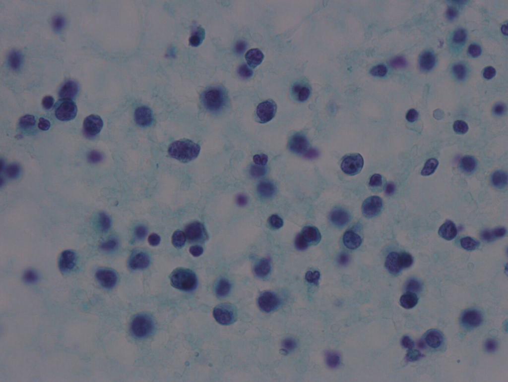 대한내과학회지 : 제 74 권 부록 1 호 2008 Figure 3. Smear showed many mature lymphocytes and large tumor cells (PP stain, 200) (). The tumor cells were positive for CD20 (Immunohistochemical stain, 200) ().